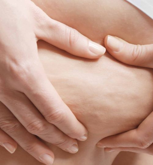 Woman with cellulite problem, closeup